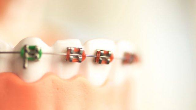 歯列矯正をお得にできる部分矯正のメリットとデメリットとは？